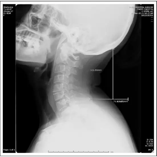 X-ray Cervical Spine Lateral